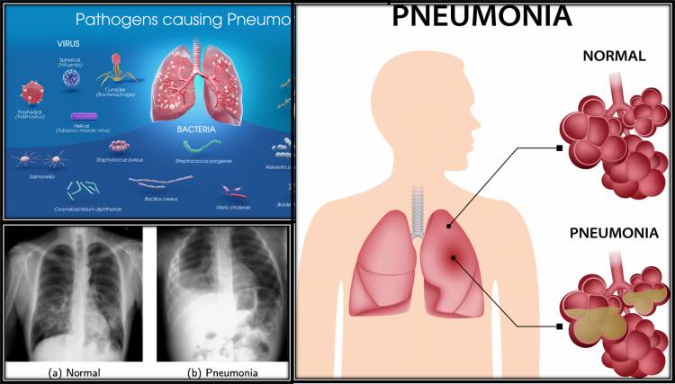 Detail Information About "PNEUMONIA"