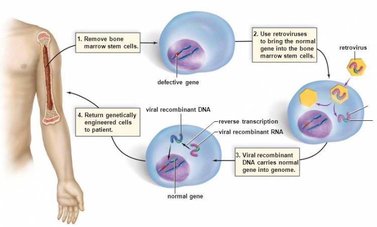 Viral vector Gene Therapy