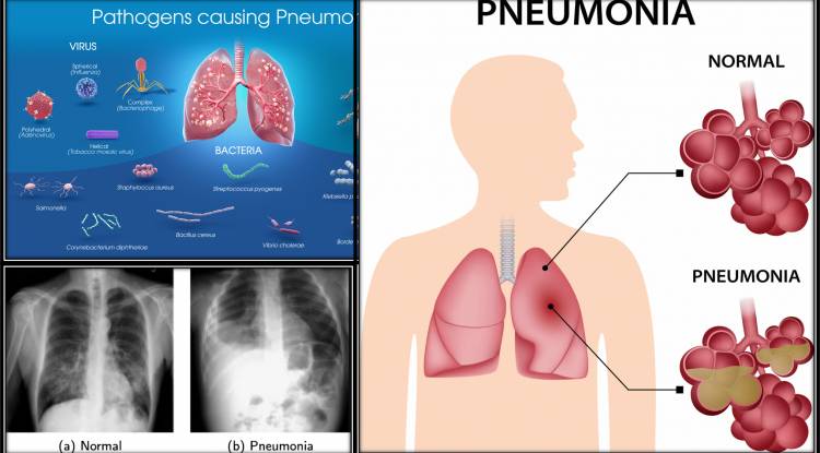 Detail Information About "PNEUMONIA"