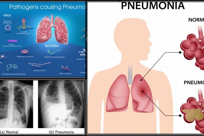 Detail Information About "PNEUMONIA"